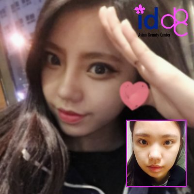Id美容外科 Twitterissa 目 鼻整形でまるで別人 幅広二重や低い鼻で悩みがある方は是非チェックしてくださいね Https T Co D0wnlnfabj まるで別人 韓国整形 美容整形レビュー