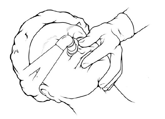 NaveenEipe's tweet image. ET connector in trumpet= Modified Nasal Trumpet- works before &amp;amp; after!