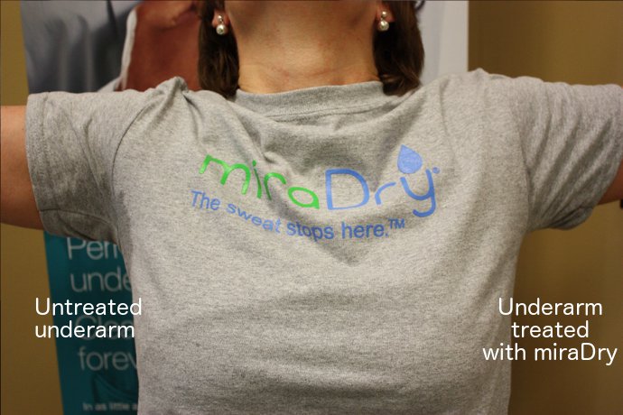 miraDry's tweet image. See the results for yourself! Check out before and after photos of those who sought #miraDry to #stopthesweat: bit.ly/2hucUbf