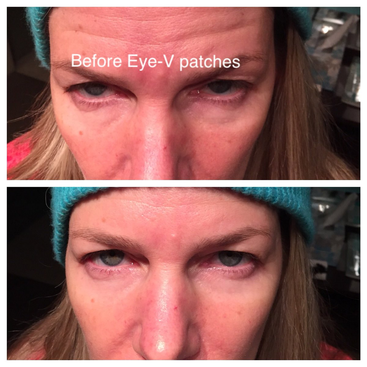 shearjoychelan's tweet photo. These #new #EyeV hydrogel patches are so cool! Check out my 20 min #results &amp; video https://t.co/EE6puBsoTn In-home #spa #eyelift #beauty https://t.co/fp4wDVZHed