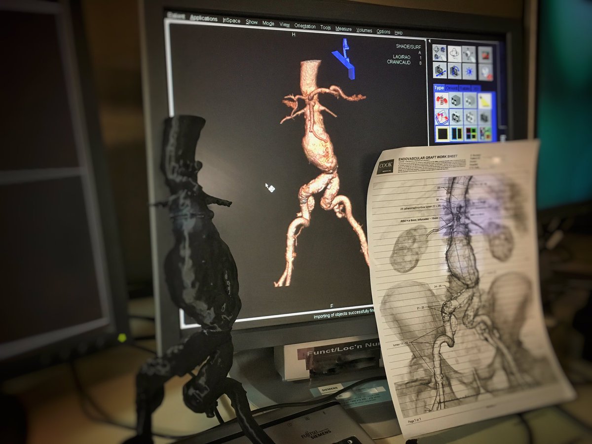 ozvascdoc's tweet photo. I like it when things go to plan. Thanks @3dmedLab π€#FEVAR #AAA #3dPrinting #3dMed #EVAR #surgtweeting https://t.co/Zll0AWdBv9
