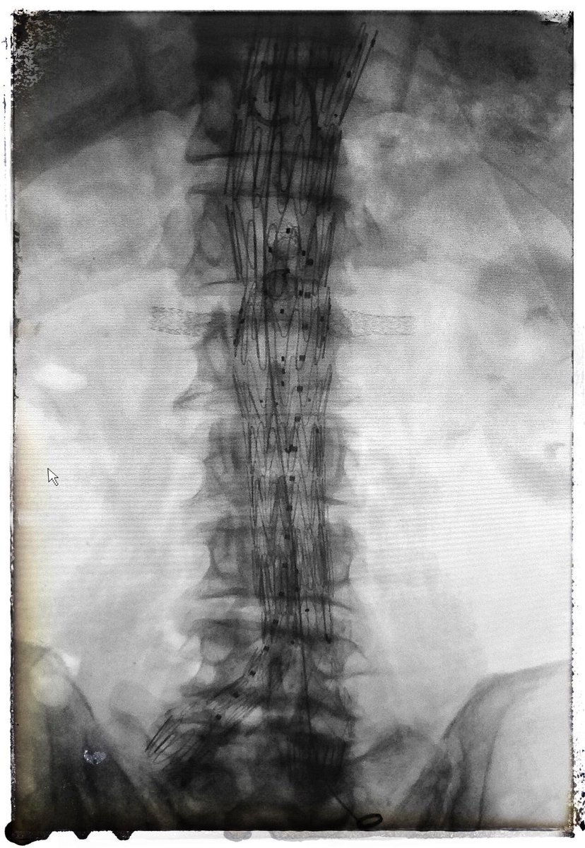 ozvascdoc's tweet photo. I like it when things go to plan. Thanks @3dmedLab π€#FEVAR #AAA #3dPrinting #3dMed #EVAR #surgtweeting https://t.co/Zll0AWdBv9