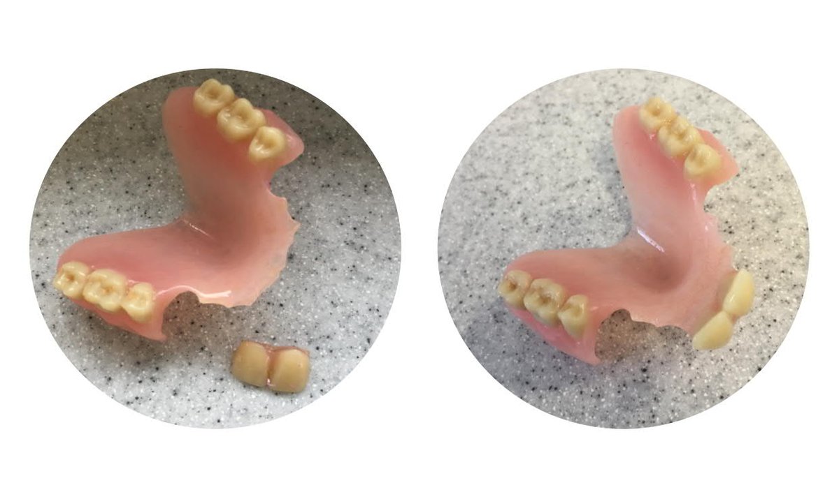 Another emergency repair #brokendenture. For a fast professional repair by our experienced technicians call 01789 292460 or pop in &amp; see us