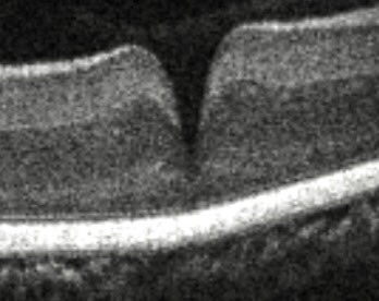 Continuing on the avian theme; #OCT of #birdsofprey v-shaped fovea. Is #vision &amp; #acuity all about contour?