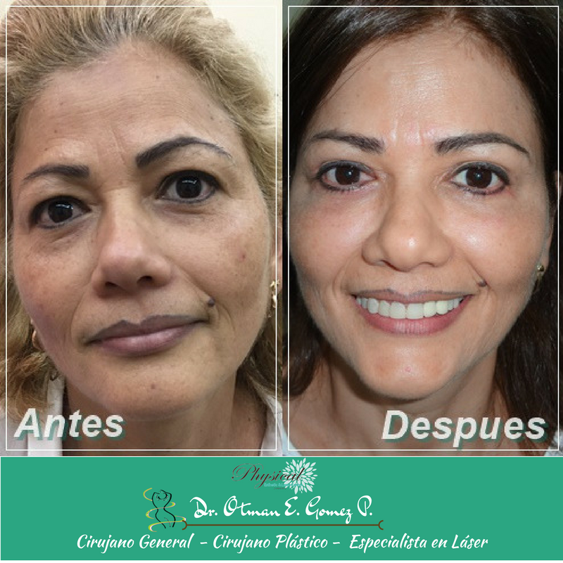 PhysicalCenterV's tweet photo. Pequeños beneficios pueden aportar varios tratamientos para hacer la diferencia en el envejecimiento facial! Visítenos #physicalestehtic https://t.co/gOpiavAV2I