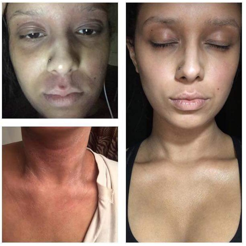 etsinmods's tweet photo. #topicalsteroidwithdrawal to #AronRegimen success! https://t.co/3W2uCv6t4P #lifeafterTSW #eczema #aronregimen #redskinsyndrome #nomoreitch https://t.co/7RviqZ741L