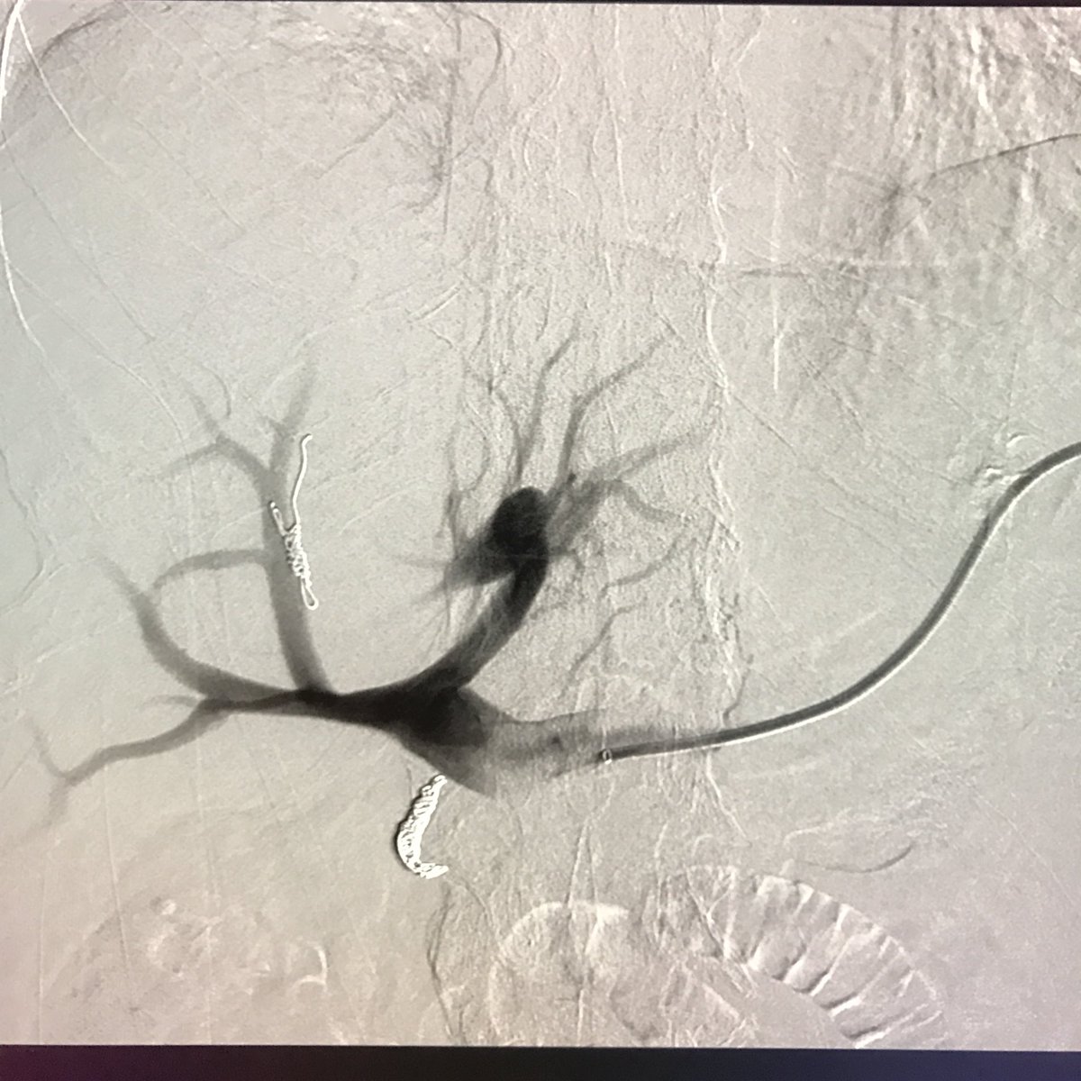 rogshw's tweet photo. Trans splenic PVE 39% growth in 3 weeks @Drshiloh @angiowoman @InterventOnc360 @#Trufill https://t.co/cXoSPh6AN1