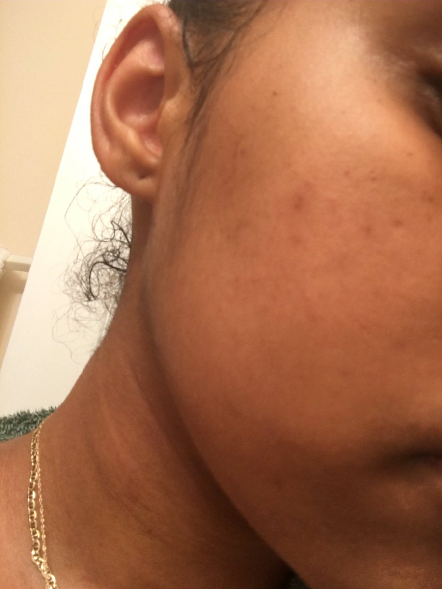 VTMNOrganic's tweet photo. Apple Crisp Facial Toner and 3 weeks later 🍎
#VTMN https://t.co/fq1uovlBAw