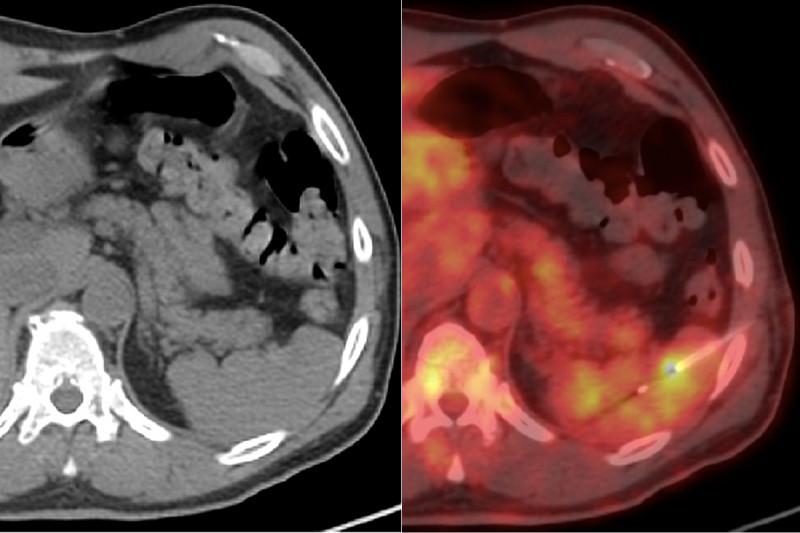 Interventional #Radiology at MSK regional sites offers patients minimally invasive cancer care closer to home: bit.ly/2k5CIHA