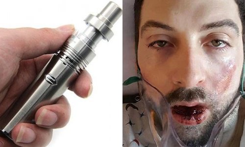 Inilah Kronologi Vape Meledak di Mulut dan Hancurkan 7 Gigi | goo.gl/kdM4PX