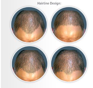 DrLopezBran's tweet photo. ¿Cómo quedaré después de mi #TrasplanteCapilar? El software 3D #ArtasHair Studio te permite ver varias simulaciones antes de la intervención https://t.co/djIcuDwPxm