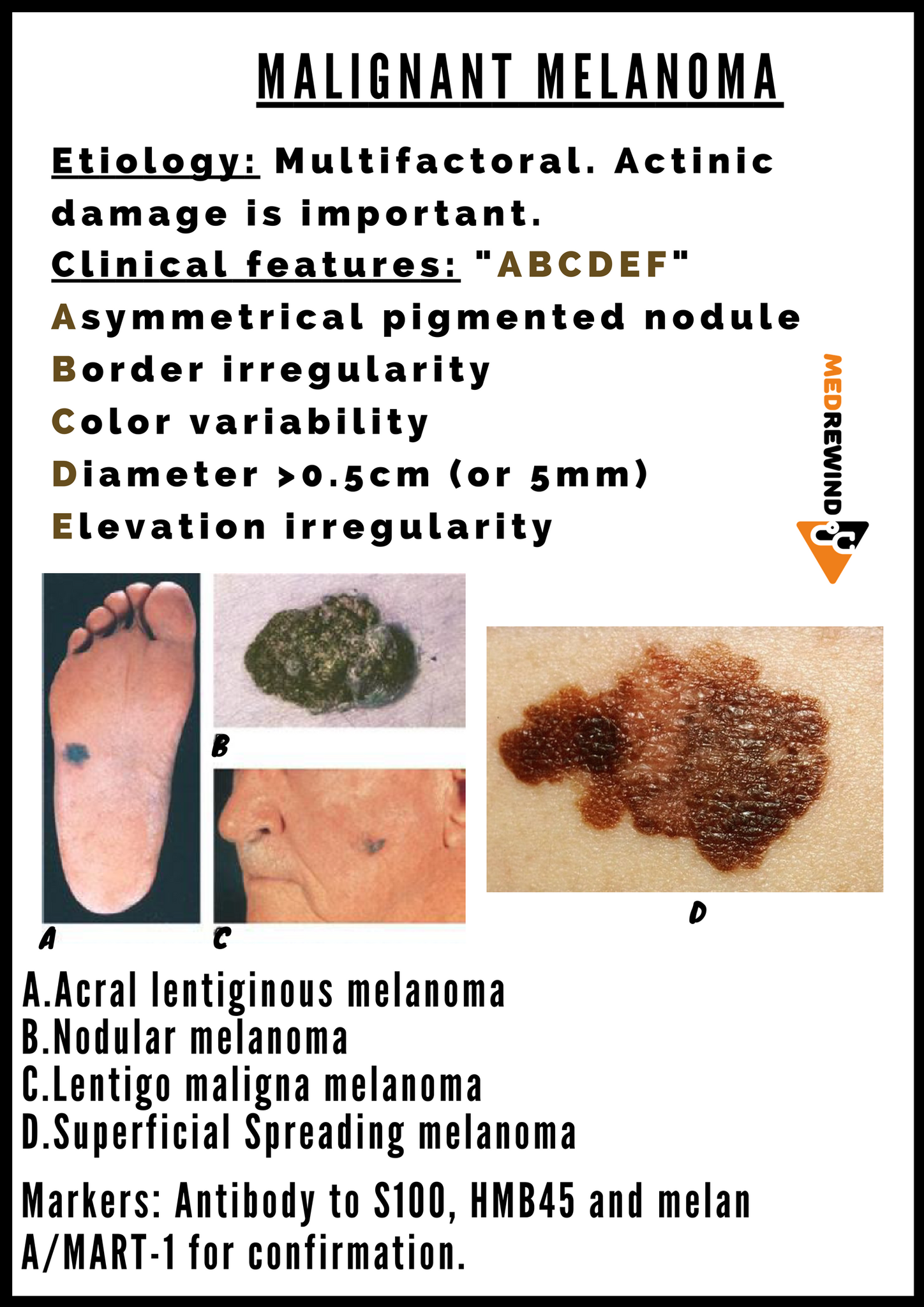 superficial spreading malignant melanoma