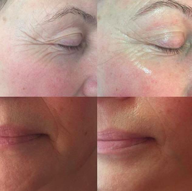 CooLiftingfr's tweet photo. #Coolifting traite le contour des yeux, les #rides du front, la ride du lion, la joue et la zone labiale
#antiage #facecare #lifting #beauty https://t.co/3fHTThHFqd