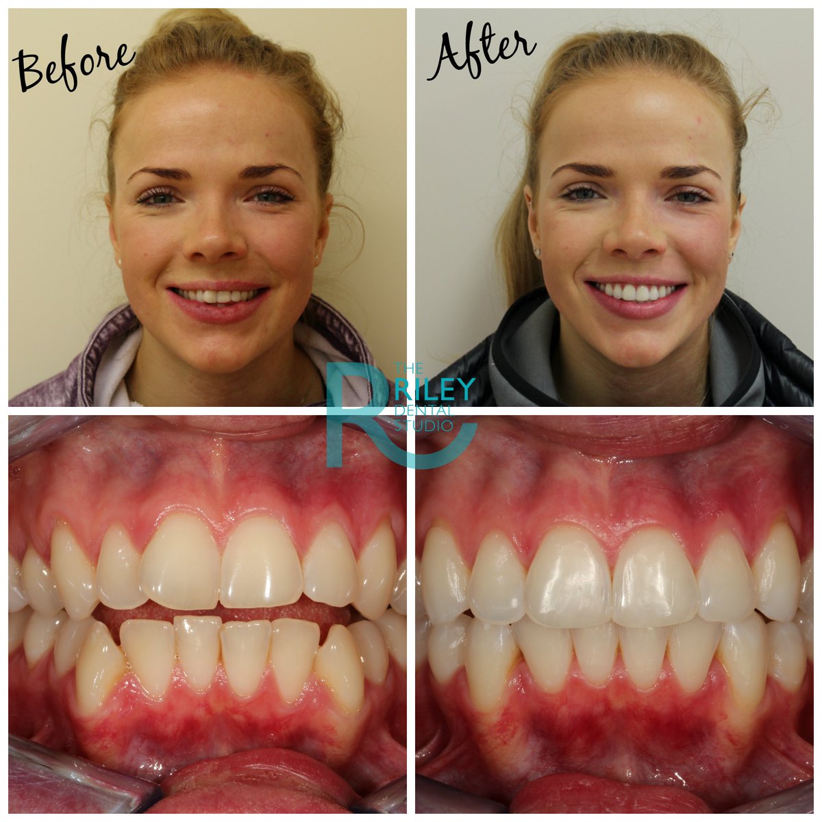 Another stunning new smile created by Gareth with #Invisalign here at #TRDS. Helena you look absolutely beautiful!