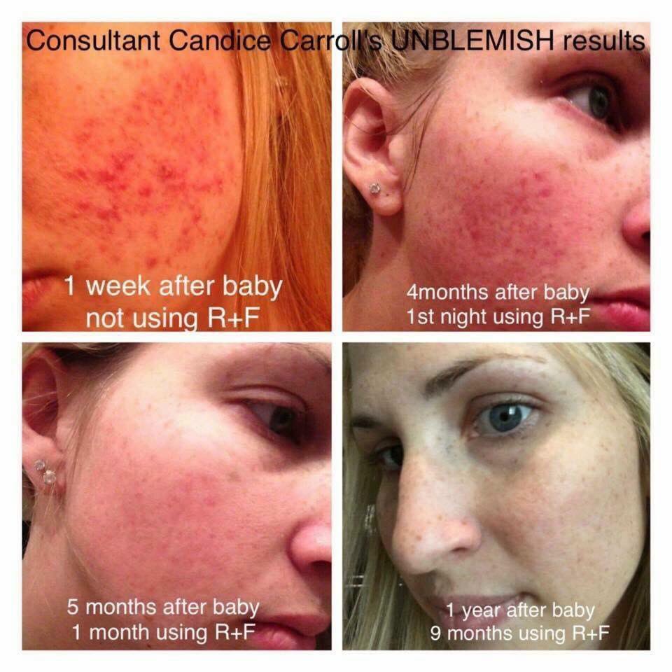 orr_selena's tweet photo. If #Acne is what you're dealing with, go with the #1 Premium Skincare for Acne..Unblemish! https://t.co/el951ZclCi