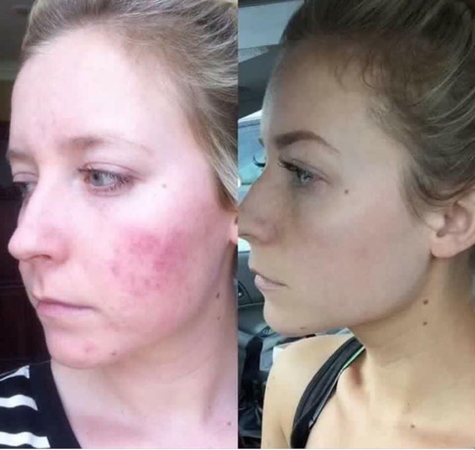 orr_selena's tweet photo. If #Acne is what you're dealing with, go with the #1 Premium Skincare for Acne..Unblemish! https://t.co/el951ZclCi