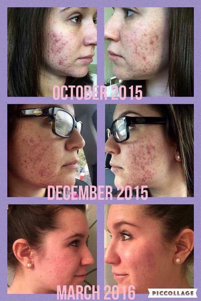 orr_selena's tweet photo. If #Acne is what you're dealing with, go with the #1 Premium Skincare for Acne..Unblemish! https://t.co/el951ZclCi