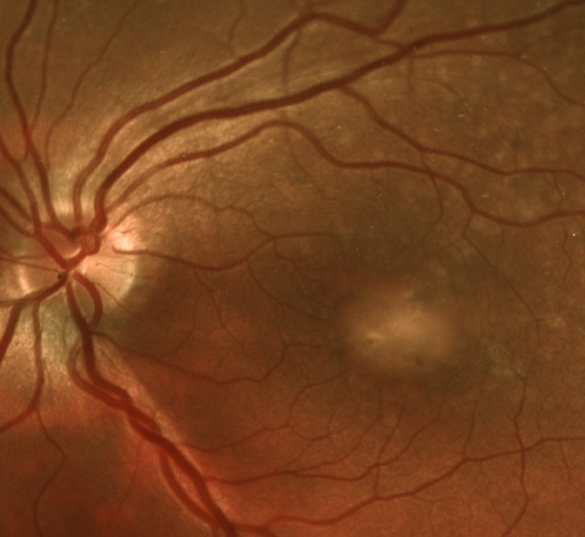 TXRetinaSurgeon's tweet photo. Adult-onset #Vitelliform Macular Dystrophy #AVMD characterized by central sub-retinal debris bright on #FAF imaging
https://t.co/0EN4pC1v3d https://t.co/ES5CdMmHxT