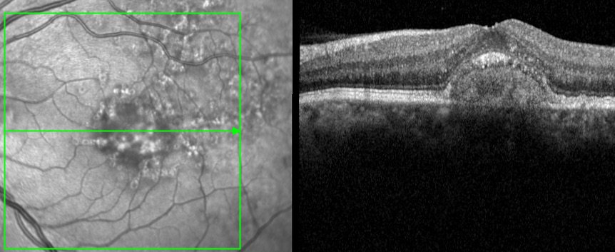 TXRetinaSurgeon's tweet photo. Adult-onset #Vitelliform Macular Dystrophy #AVMD characterized by central sub-retinal debris bright on #FAF imaging
https://t.co/0EN4pC1v3d https://t.co/ES5CdMmHxT