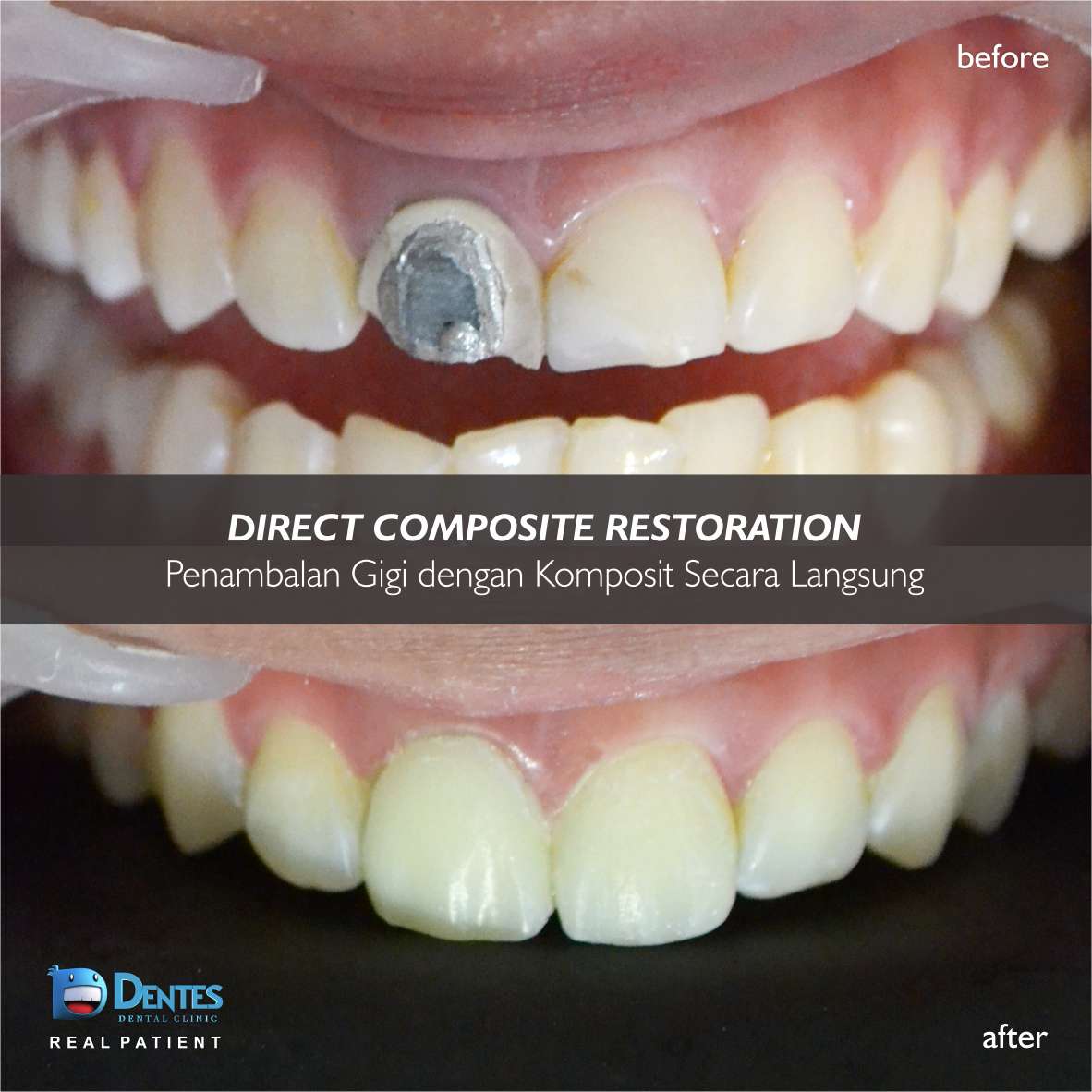 klinikdentes's tweet image. If you don't have a smile, We will give you one and you can use it everyday! :)
#directcomposite #tambalgigi #tambalgigidepan