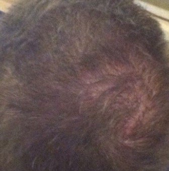 Hairtransplant_'s tweet photo. #hairtransplant post op slow growth, no growth or #shockloss? https://t.co/wNB8ji6w8G #fuehairtransplant #thinninghair https://t.co/bjRxFbp0wT
