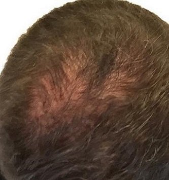Hairtransplant_'s tweet photo. #hairtransplant post op slow growth, no growth or #shockloss? https://t.co/wNB8ji6w8G #fuehairtransplant #thinninghair https://t.co/bjRxFbp0wT