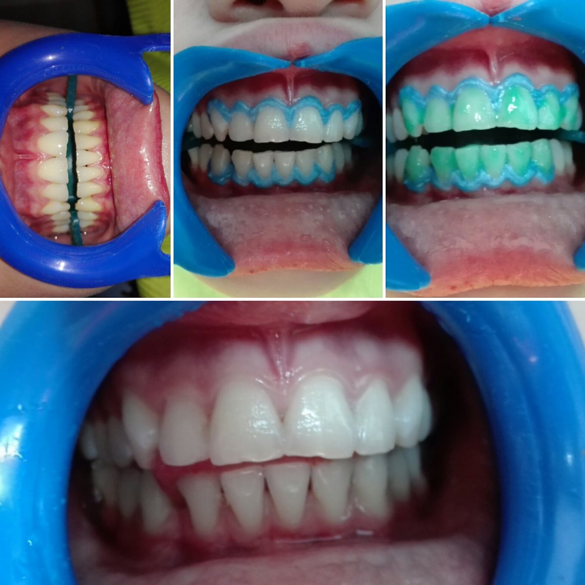 Paciente satisfecha👌💯
Interesado en recuperar tu confianza y sonreír !!! 😁 comunicate al # 
📱32414252 📱 será un placer atenderle.