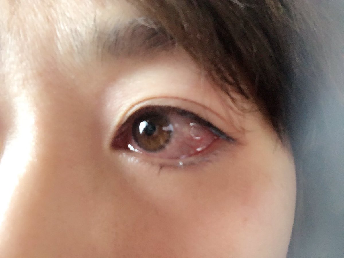 Akinbo Twitterren 風邪をひいた後 目が充血してしまいました