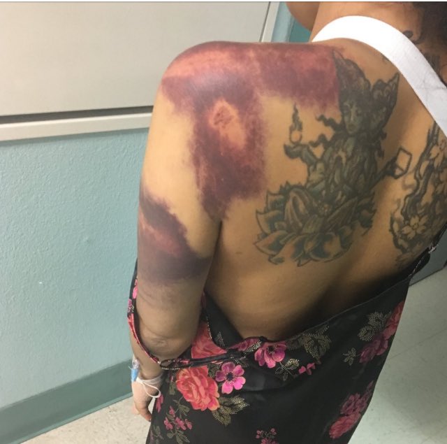 pettyblackgirI's tweet photo. TW:// domestic violence, abuse, bruises 

Angela was beat by an ex boyfriend for trying to leave the relationship &amp; left for dead. https://t.co/SsiFg8rn3Q