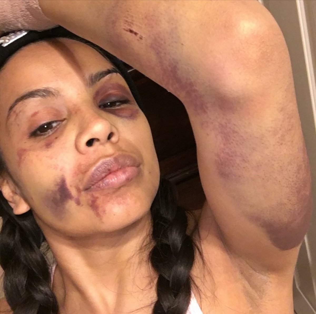 pettyblackgirI's tweet photo. TW:// domestic violence, abuse, bruises 

Angela was beat by an ex boyfriend for trying to leave the relationship &amp; left for dead. https://t.co/SsiFg8rn3Q