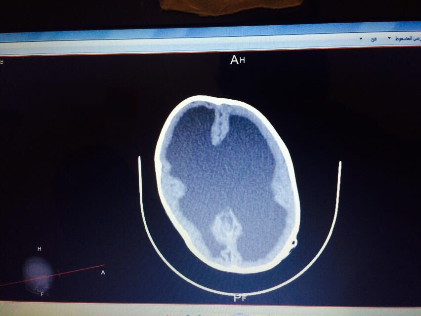 Majed1Albalawi's tweet photo. حالة طارئة: #طفلة_بحاجة_ماسة للقبول في المستشفى التخصصي أو الحرس الوطني بالرياض لعلاج الحالة 
للتواصل مع والد الطفلة / 0599692266 https://t.co/GyPJbJ2t2L