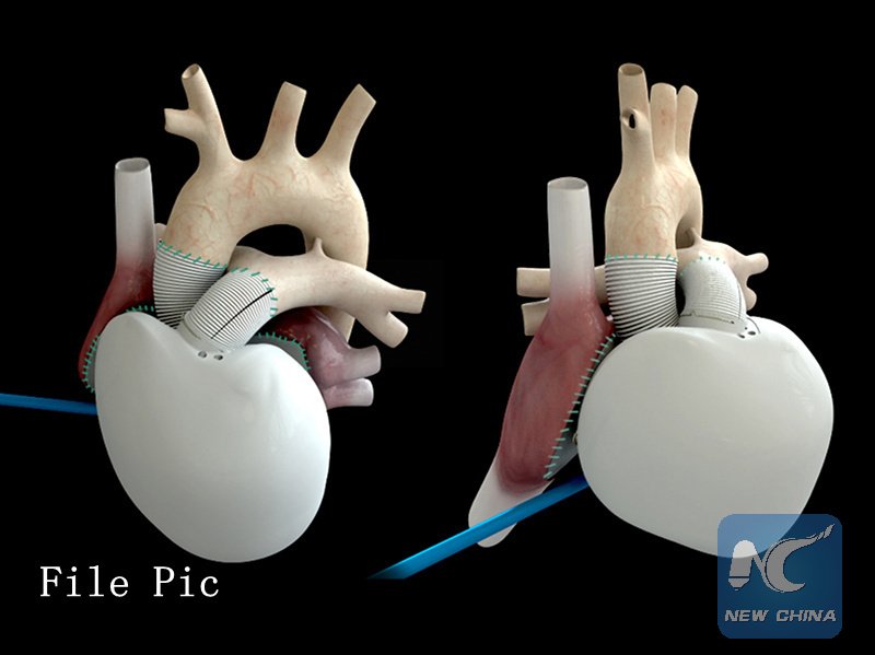 Çinli cerrahlar, ameliyatta kullanmak üzere, 3 boyutlu yazıcı ile hastanın kalbinin modelini yapıyor xhne.ws/12HlN