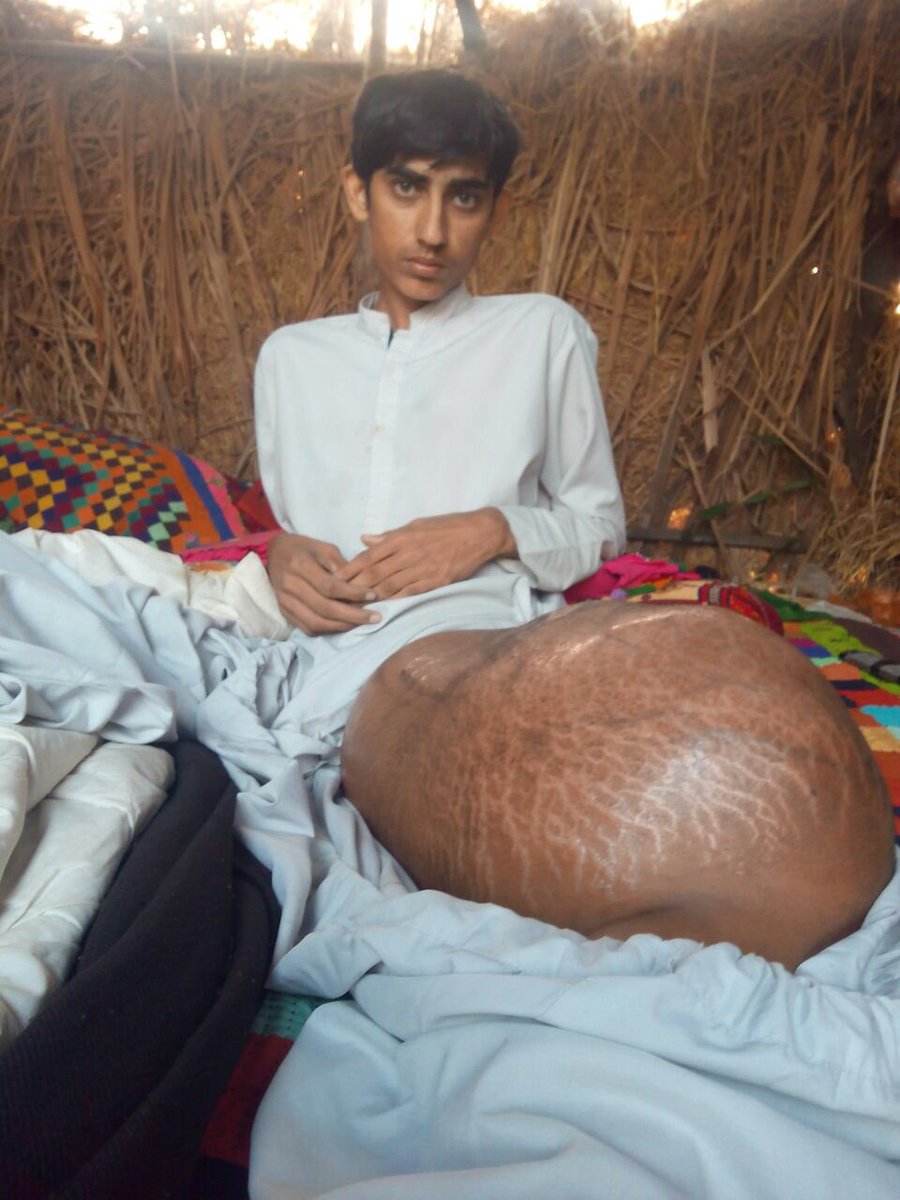 #شبير_البلوشي
تم ادخاله المستشفى في باكستان
قرروا الأطباء بتر كامل الرجل
مع جرعات كيماوي
العلاج كاملا والسكن يكلف ٣٠٠٠٠ريال
من يتكفل به ؟