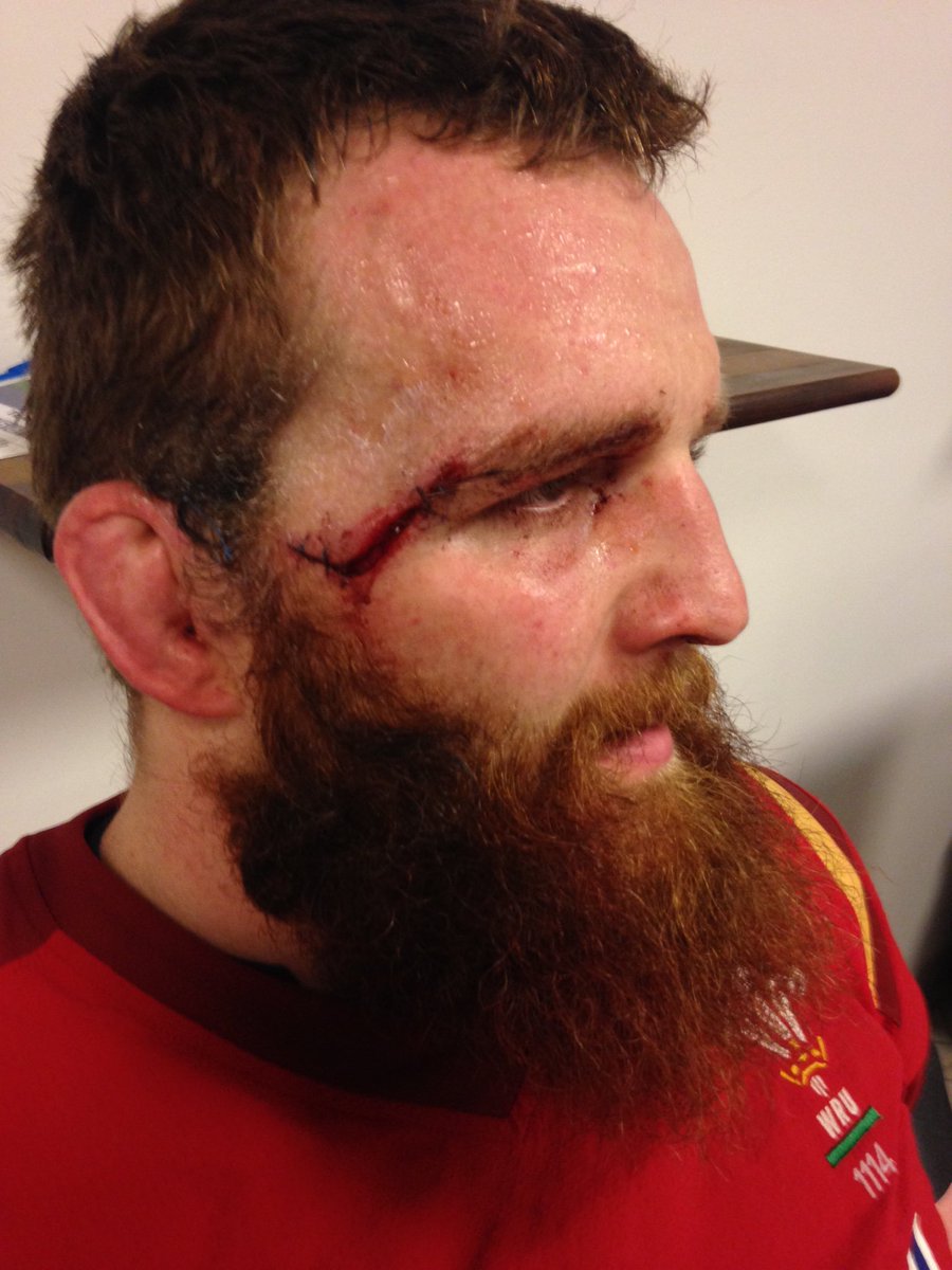 Jake_Ball4's tweet photo. Great to get off to winning ways yesterday in Italy. Thanks to @rhyslw65 for the tidy stitching job @WelshRugbyUnion @SixNationsRugby https://t.co/sngSS0ggYr