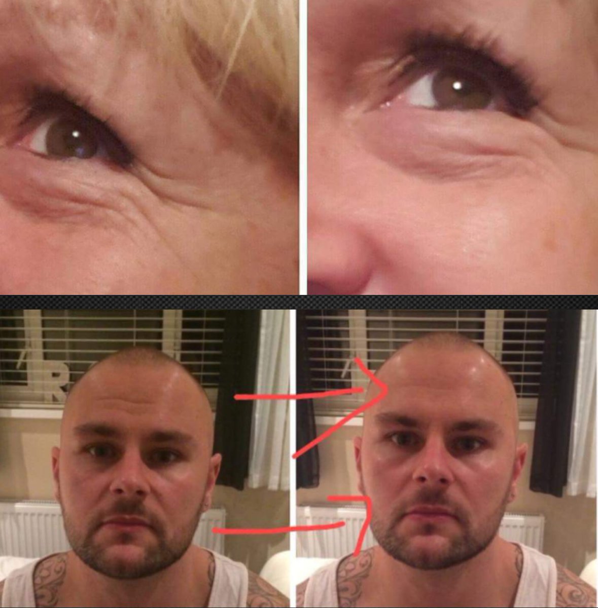 VBextensions's tweet image. Results from one use of &apos;botox in a bottle&apos; 
Contact me for prices ❤