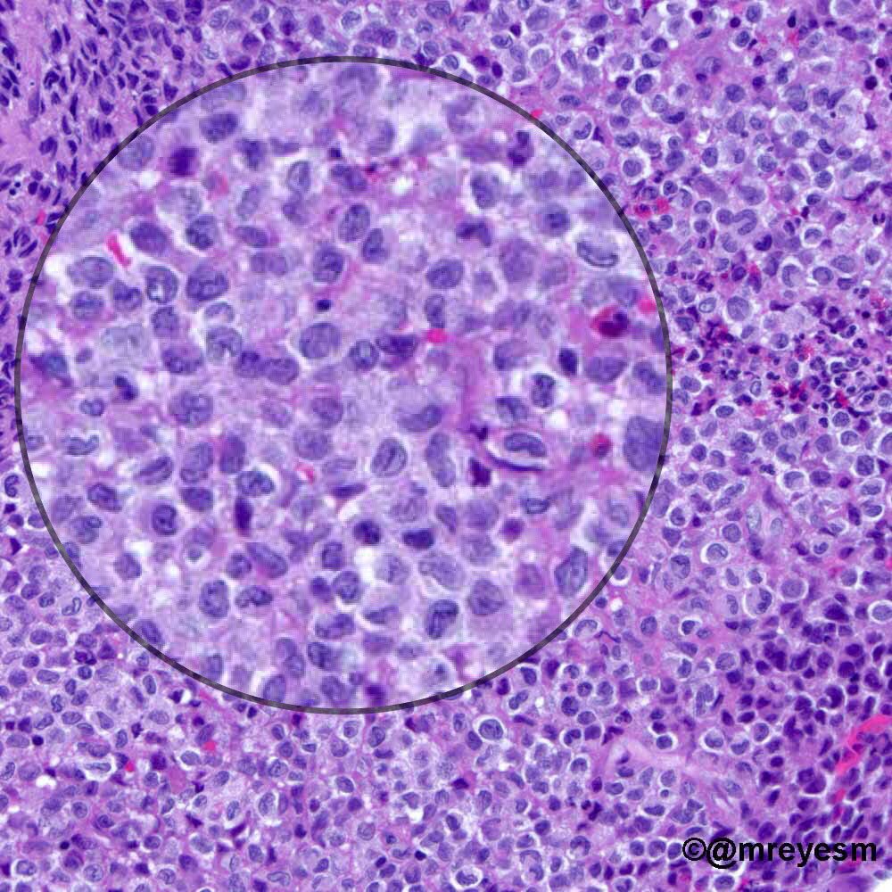 Sanjay Mukhopadhyay (@smlungpathguy) on Twitter photo Langerhans cells: check out these twisted sistas from a post by <a href="/mreyesm/">Miguel Reyes-Múgica</a> Thank you <a href="/pembeoltulu/">Pembe Oltulu, MD</a> for teaching me this cool trick! #pathology Langerhans cells: check out these twisted sistas from a post by <a href="/mreyesm/">Miguel Reyes-Múgica</a> Thank you <a href="/pembeoltulu/">Pembe Oltulu, MD</a> for teaching me this cool trick! #pathology