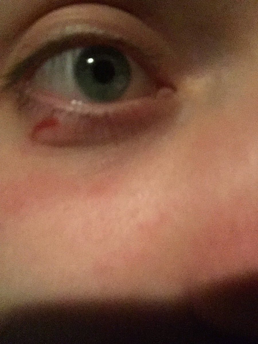 JReichinn's tweet image. When dancing on Saturday night results in an L. #illbounceback #gurls