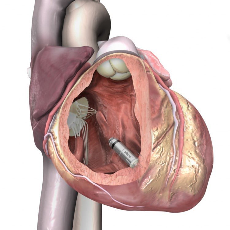 news24tvchannel's tweet photo. World's smallest pacemaker launched to normalise your heart rate. Check out #Normalise #heartrate #smallestpacemaker https://t.co/nAPNy9qwK7 https://t.co/fjM6u11GvY