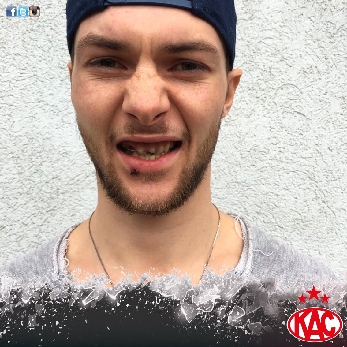 Warum <a href="/PKsauce19/">Philipp Kreuzer</a> gestern mit Gitter spielte? Weil er am Donnerstag zwei ganze und zwei halbe Zähne in Bolzano "gelassen" hat. #Rotjacken