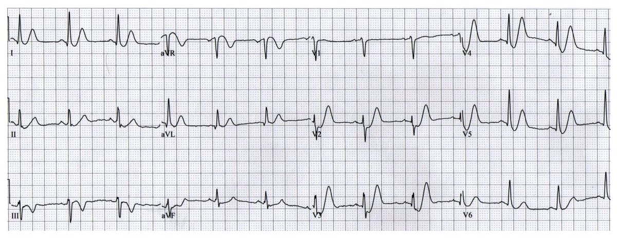 Great case of Dewinter syndrome last evening. A must recognize ECG finding for emerg docs. goo.gl/a8QlSX   goo.gl/D4Igbn