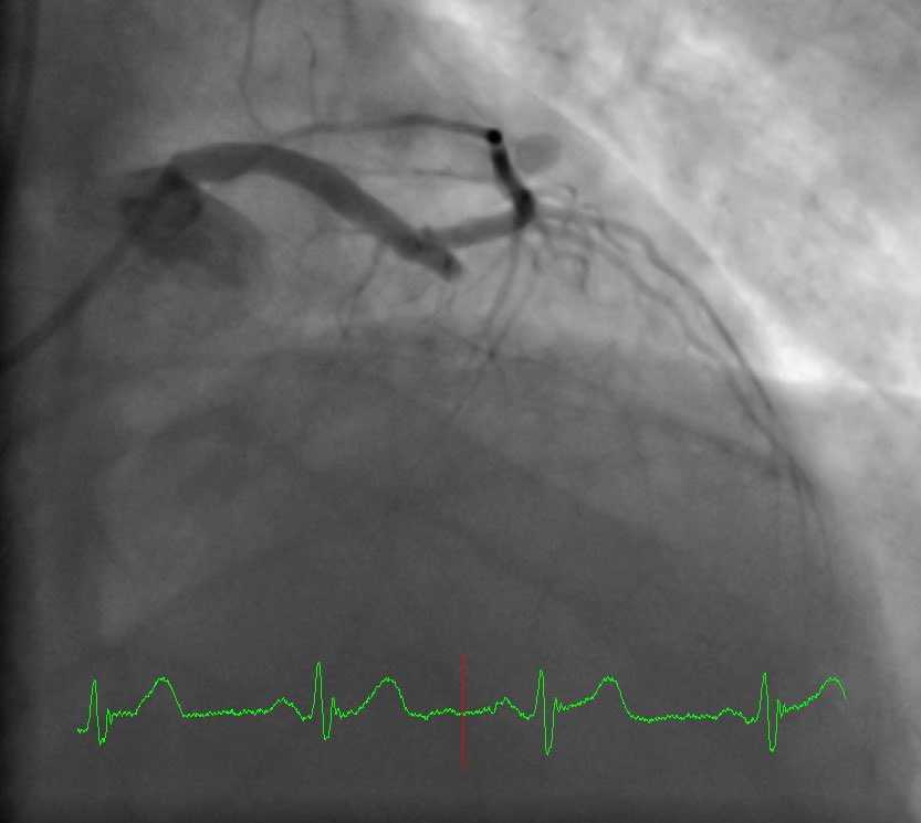 DrVal_Iz's tweet image. Anterior #STEMI #RadialFirst. Loving what I do @uvahealthnews