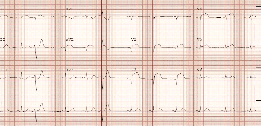 DrVal_Iz's tweet image. Anterior #STEMI #RadialFirst. Loving what I do @uvahealthnews