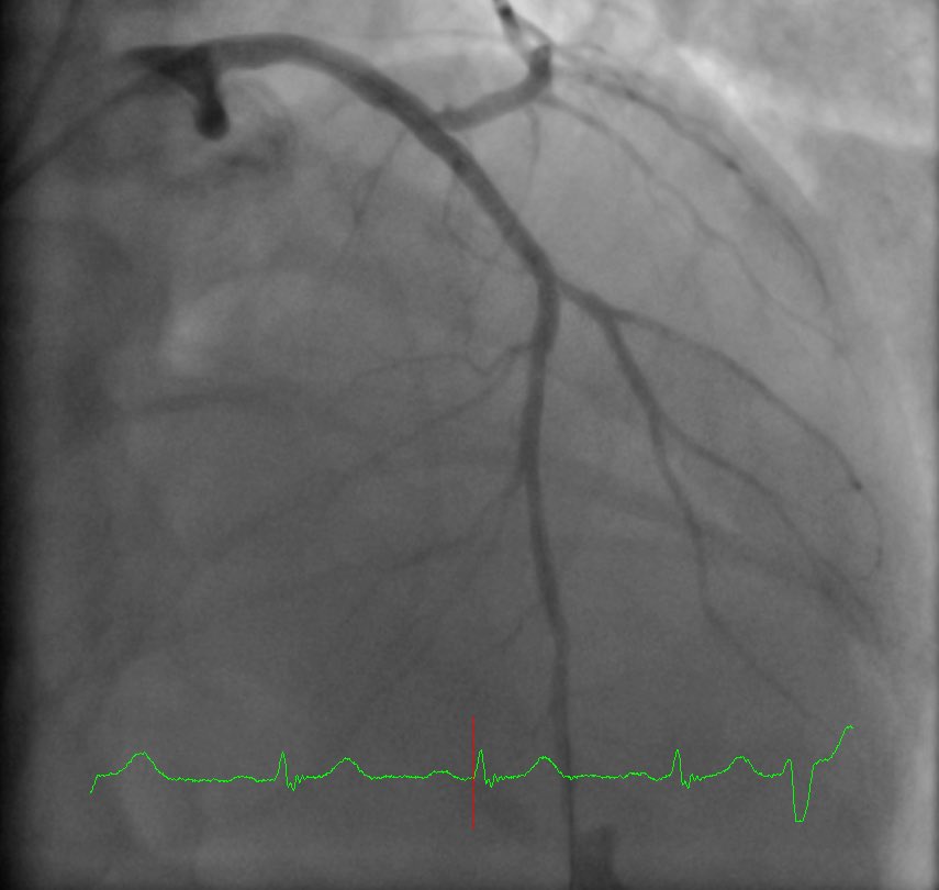 DrVal_Iz's tweet image. Anterior #STEMI #RadialFirst. Loving what I do @uvahealthnews