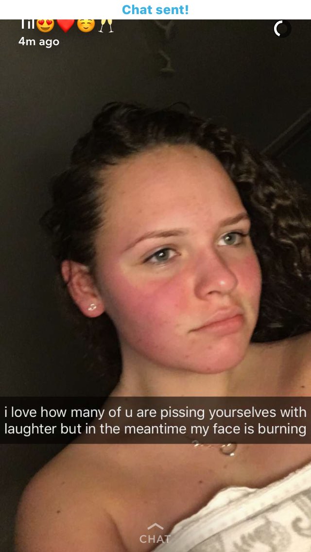 Daisyjaynexo's tweet photo. Today , @TilLongbottom learnt that one exfoliator at a time really is enough . #prayfortilly #sendaloefortilly #useice?? https://t.co/xcx9qHKIZn