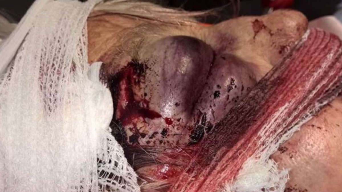 BeebJournalist's tweet photo. 75-year-old Naomi Roberts after having her handbag stolen in Eastville Park, Bristol. Her daughter says her eye socket is fractured. https://t.co/k51LMrRCe6