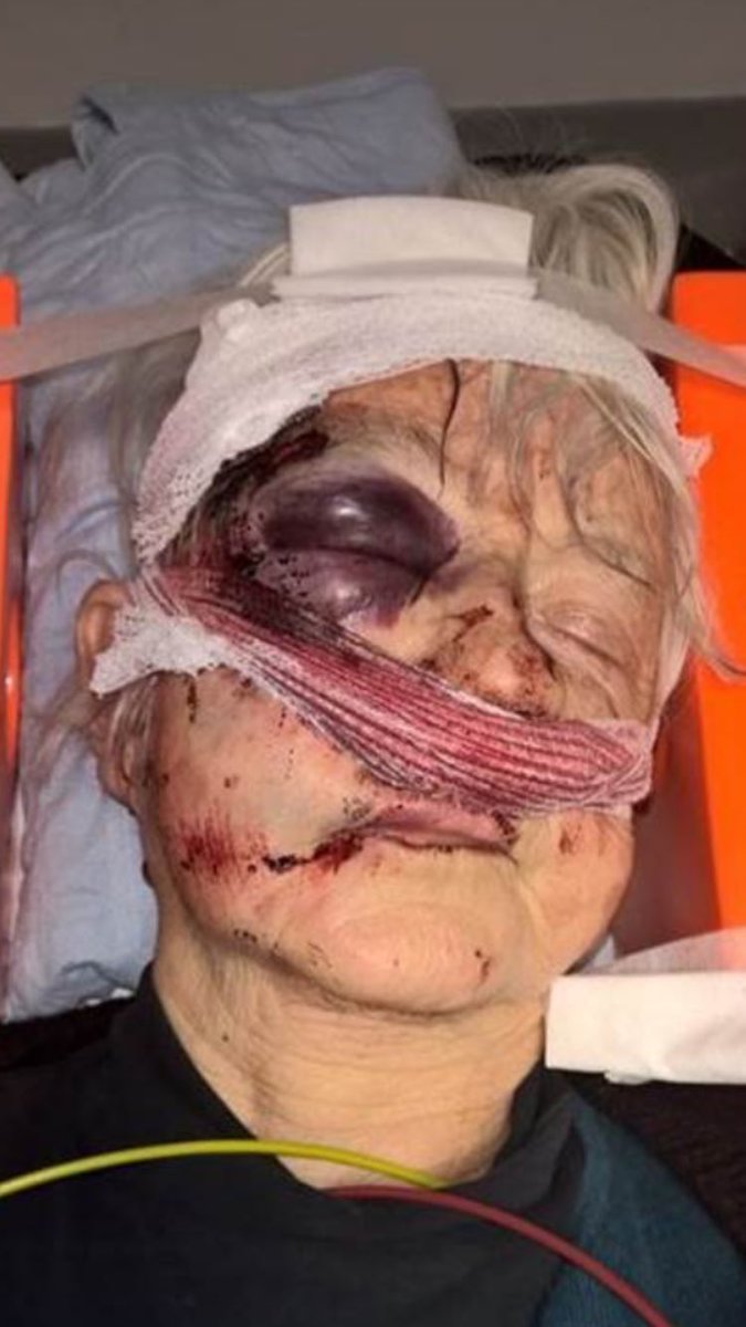 BeebJournalist's tweet photo. 75-year-old Naomi Roberts after having her handbag stolen in Eastville Park, Bristol. Her daughter says her eye socket is fractured. https://t.co/k51LMrRCe6