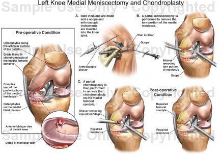 jitendra000557's tweet image. Superb Tricks for #CPTcode 29881, 29880 and 29877 #surgerycoding #medicalcoding #icd10 #codingtips #aapc #ahima sumo.ly/sqUf