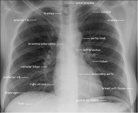 medicalce's tweet photo. How to Read a Chest X-ray Lesson 1 https://t.co/ALmoRRa0yW https://t.co/IqBodkgN7W