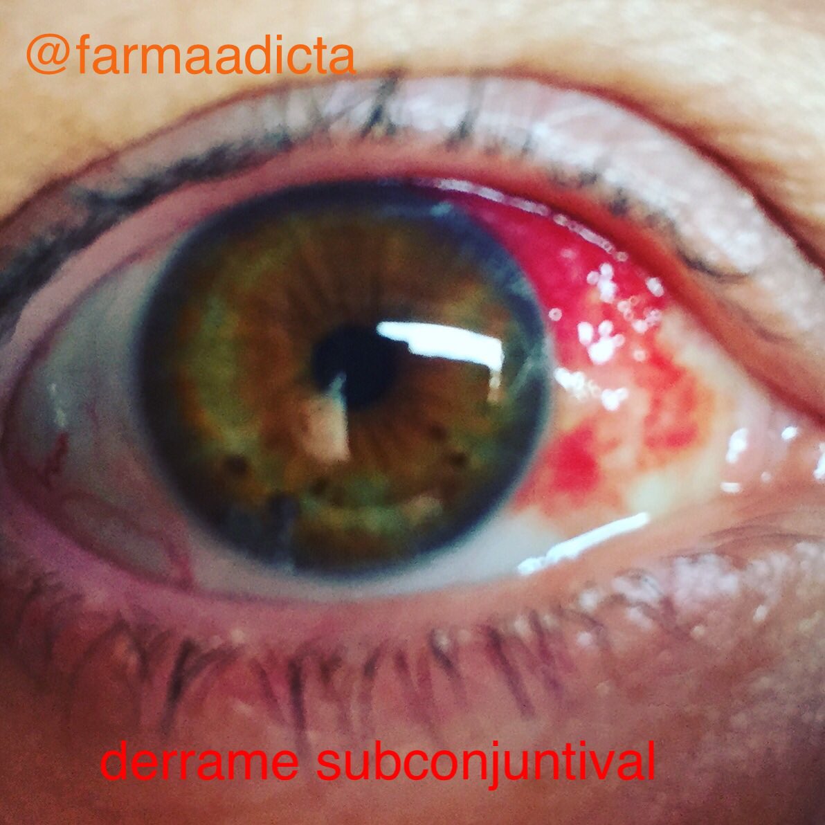 Farmaadicta's tweet photo. Todo lo que debes saber sobre el #derramesubconjuntival #hiposfagma o #derrameocular muy pronto en el #blog #farmaadicta #farmadicta https://t.co/OjxIeBNYhY