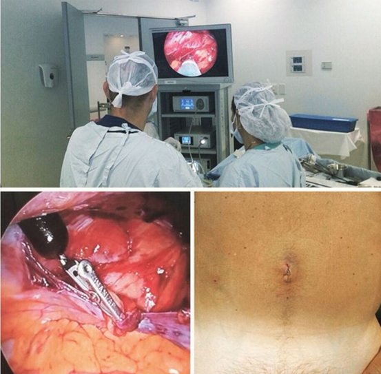 sinhuella's tweet photo. Cirugía laparoscópica de hernia inguinal izquierda “híbrida” asistida con imanes... https://t.co/YISw67RJNl https://t.co/AJi8f5naL2